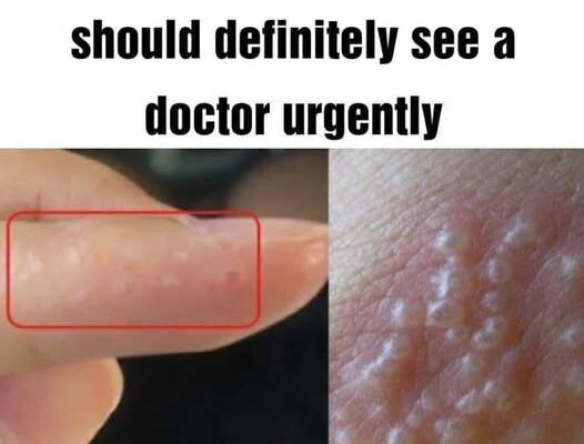 If you see these painful red bumps, you may have dyshidrotic eczema
