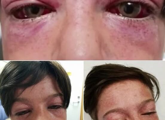 Playground Craze Leaves 11-Year-Old Boy “Looking Like An Alien” – Mom Shares Grave Warning For All Parents