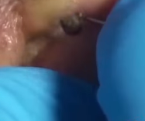 ST, Magot removal…