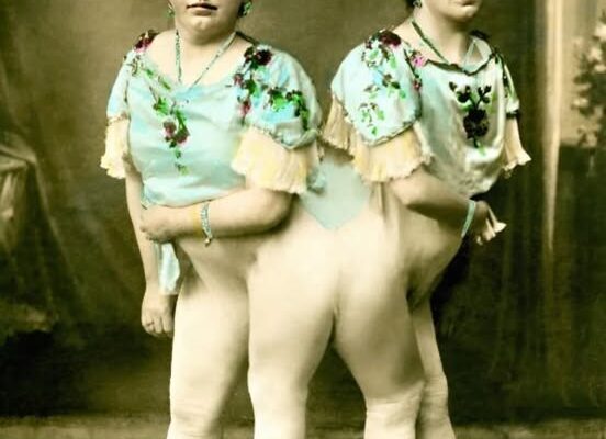 One of the Siamese Twins Got Pregnant and Gave Birth to a Son: This Is What Their Baby Looks Like