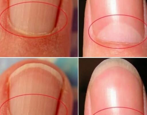 HT10. What does the half moon at the base of the nails mean?