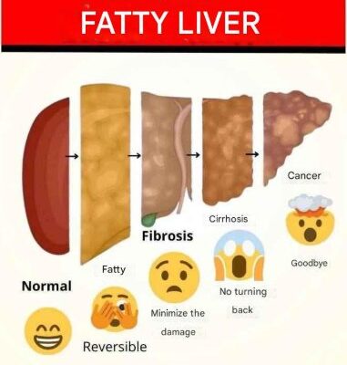 HT10. CLEANSES FATTY LIVER