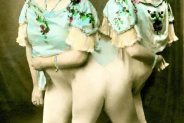 ST, ST1. The Incredible Story of the Siamese Twins: One Fell in Love, Had a Baby — and Both Became Mothers…