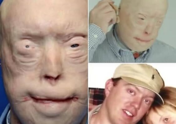 Firefighter suffers third-degree burns – this is him 7 years later