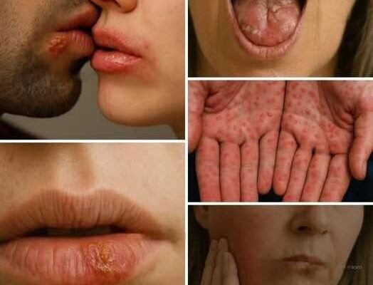 HT10. Don’t Underestimate It: Recognizing the Early Signs of Oral Can…