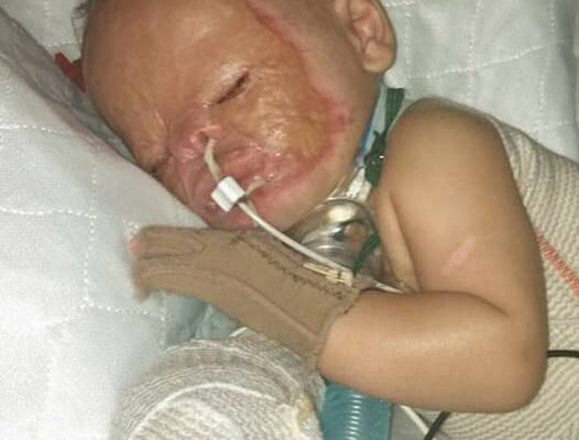 Foster baby is adopted 7 years after apartment fire left him with h0rrific bu rns…