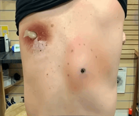 ST, Infected Sebaceous Cyst