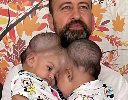 These sisters were born with fused heads 😨. They shared a cranial bone, and the separation surgery could have ended very badly 😢. When the girls turned 3, doctors decided to perform the operation. The surgery lasted 14 hours and was successful 😍. Today, the parents can hug each daughter separately 💖. Curious how the sisters look now? Their photos after the separation were shown in the first comment ⬇️⬇️