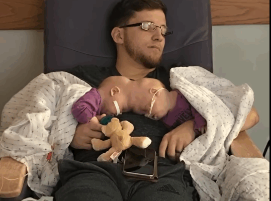 Siamese twin sisters were born with their heads joined, but at 1 year old doctors separated them: Here’s what the girls look like today