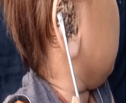 ST. Ear Cleaning Special