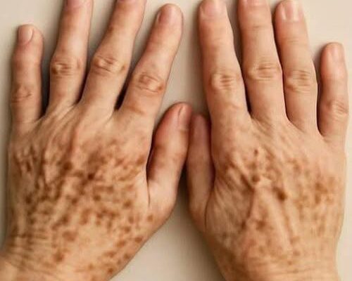 Spots on the Hands: Are They The Signs of Melanoma – The Most Dan.gerous Form Of Skin Can.cer?