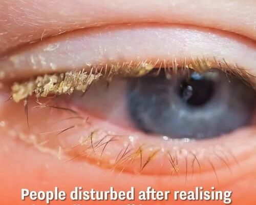 People disturbed after realising what yellow stuff in your eyes when you wake up actually is