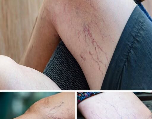 If you have purple veins on your legs, it means you are…See more