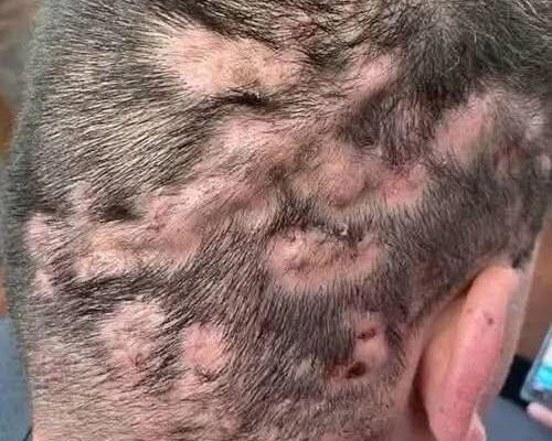 These are the first symptoms that are cre… See more