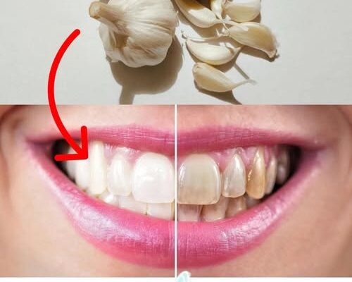 Improve your oral health naturally with garlic