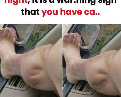 What Do Leg Cramps Reveal About Your Kidney Health?