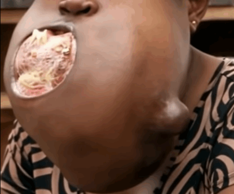 ST. Doctors remove a giant tumor from a girl’s jaw