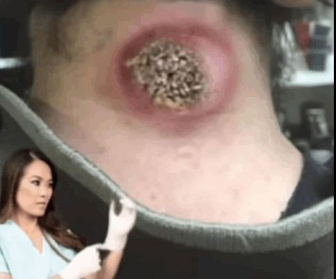 ST. Their acne is severes