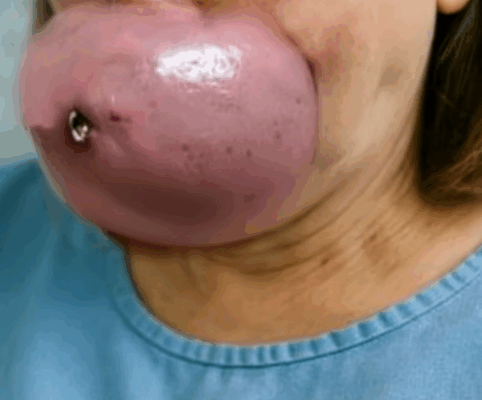 ST. Teen Undergoes 14-Hour Surgery To Remove Life-Threatening Face Tumor