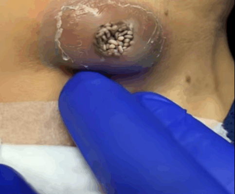 ST. full shrink lipoma lumps